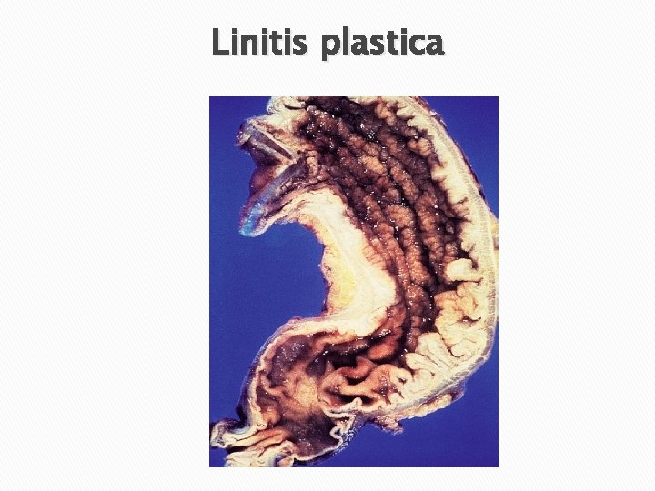 Linitis plastica 