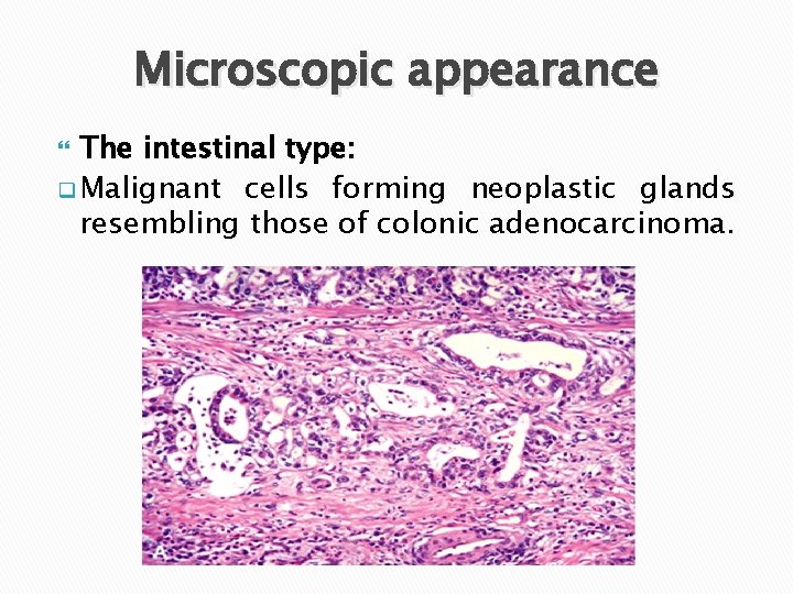 Microscopic appearance The intestinal type: q Malignant cells forming neoplastic glands resembling those of