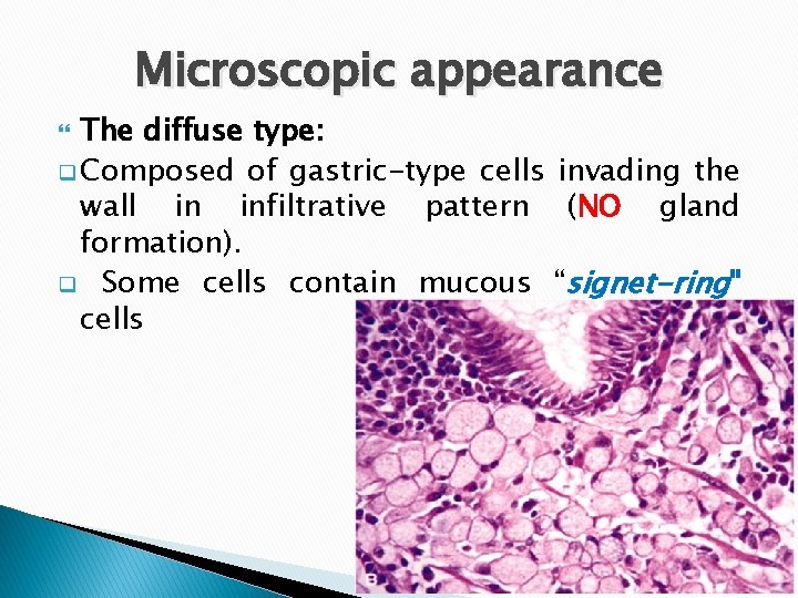 Microscopic appearance The diffuse type: q Composed of gastric-type cells invading the wall in