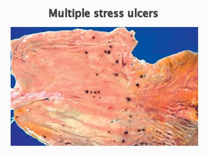 Multiple stress ulcers 