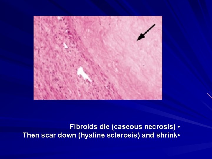 Fibroids die (caseous necrosis) • Then scar down (hyaline sclerosis) and shrink • 