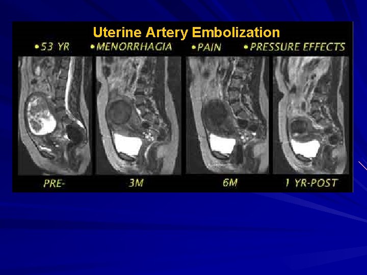 Uterine Artery Embolization 