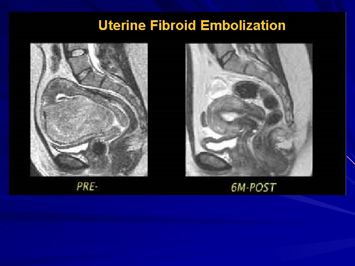 Uterine Fibroid Embolization 