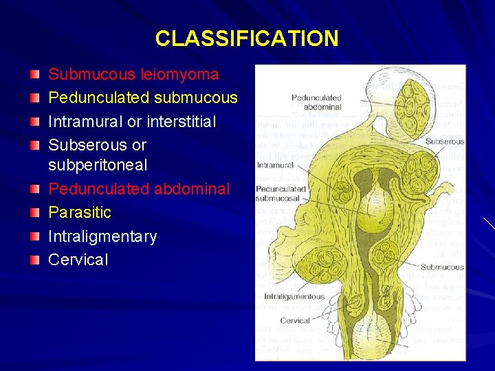CLASSIFICATION Submucous leiomyoma Pedunculated submucous Intramural or interstitial Subserous or subperitoneal Pedunculated abdominal Parasitic