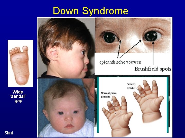 Down Syndrome Wide “sandal” gap Simi 