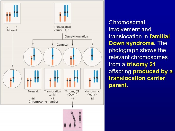 Chromosomal involvement and translocation in familial Down syndrome. The photograph shows the relevant chromosomes