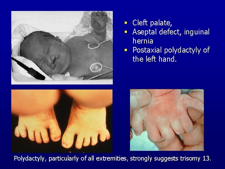 § Cleft palate, § Aseptal defect, inguinal hernia § Postaxial polydactyly of the left