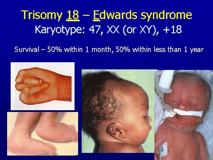 Trisomy 18 – Edwards syndrome Karyotype: 47, XX (or XY), +18 Survival – 50%