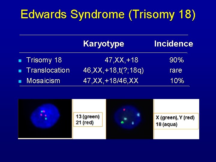 Edwards Syndrome (Trisomy 18) Karyotype n n n Trisomy 18 Translocation Mosaicism 47, XX,