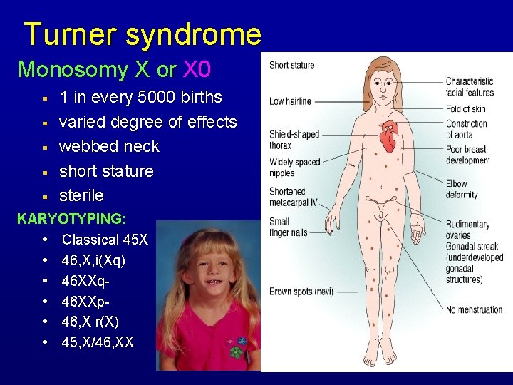 Turner syndrome Monosomy X or X 0 § § § 1 in every 5000