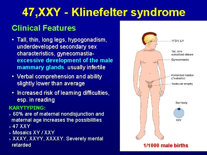 47, XXY - Klinefelter syndrome Clinical Features • Tall, thin, long legs, hypogonadism, underdeveloped