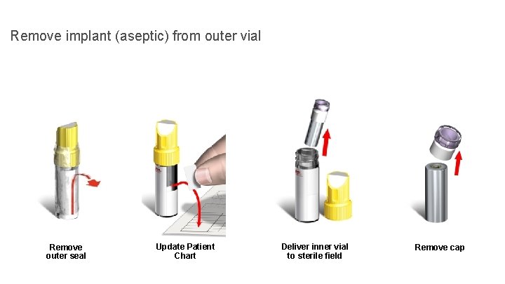 Remove implant (aseptic) from outer vial Remove outer seal Update Patient Chart Deliver inner