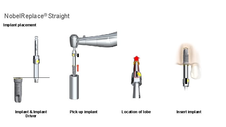 Nobel. Replace® Straight Implant placement Implant & Implant Driver Pick up implant Location of