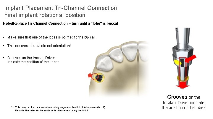 Implant Placement Tri-Channel Connection Final implant rotational position Nobel. Replace Tri-Channel Connection – turn