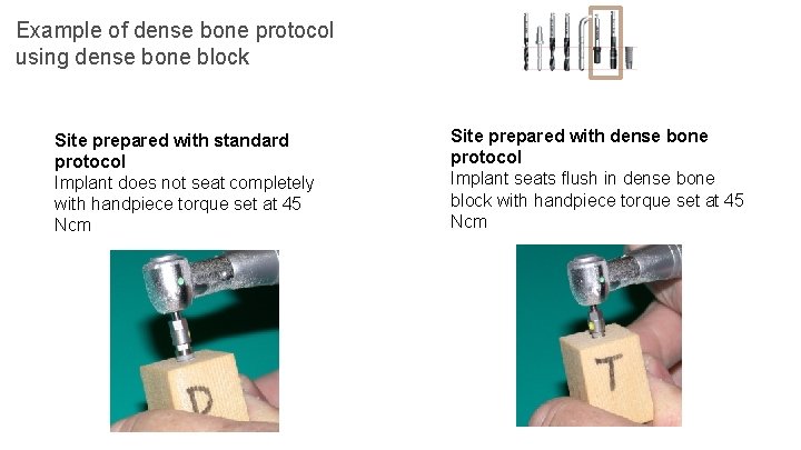 Example of dense bone protocol using dense bone block Site prepared with standard protocol