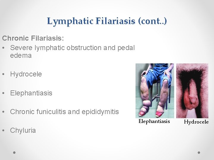 Lymphatic Filariasis (cont. . ) Chronic Filariasis: • Severe lymphatic obstruction and pedal edema