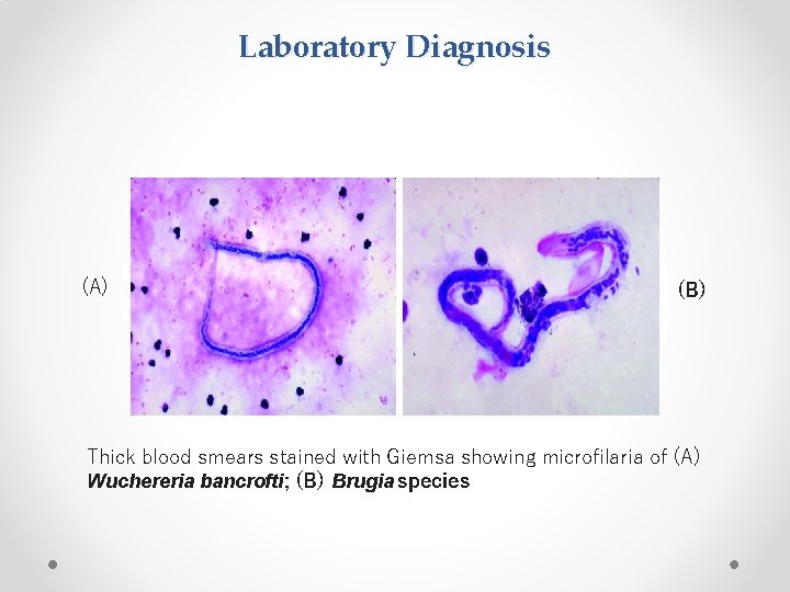 Laboratory Diagnosis (A) (B) Thick blood smears stained with Giemsa showing microfilaria of (A)