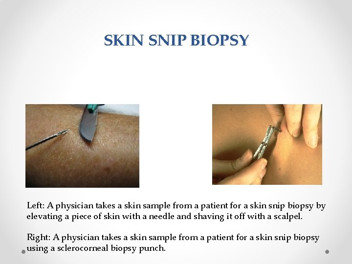 SKIN SNIP BIOPSY Left: A physician takes a skin sample from a patient for