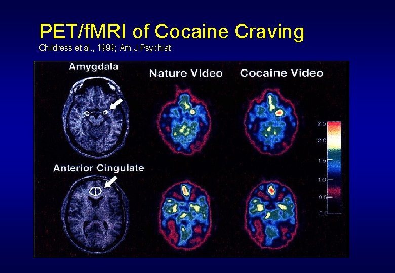 PET/f. MRI of Cocaine Craving Childress et al. , 1999; Am. J. Psychiat 