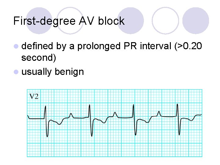 First-degree AV block l defined by a prolonged PR interval (>0. 20 second) l