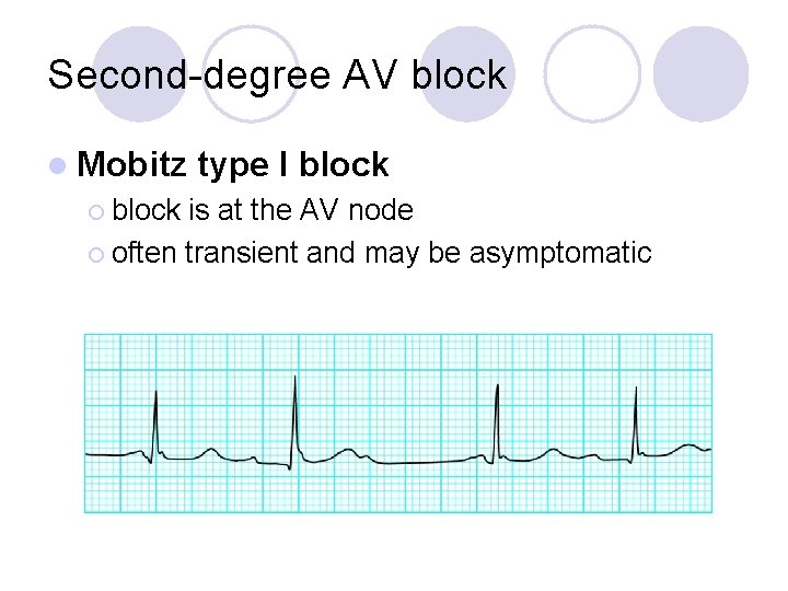 Second-degree AV block l Mobitz ¡ block type I block is at the AV