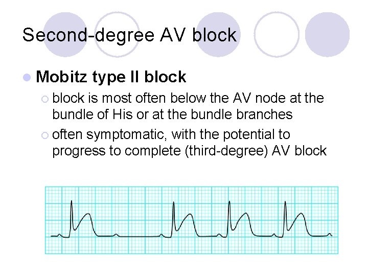 Second-degree AV block l Mobitz ¡ block type II block is most often below