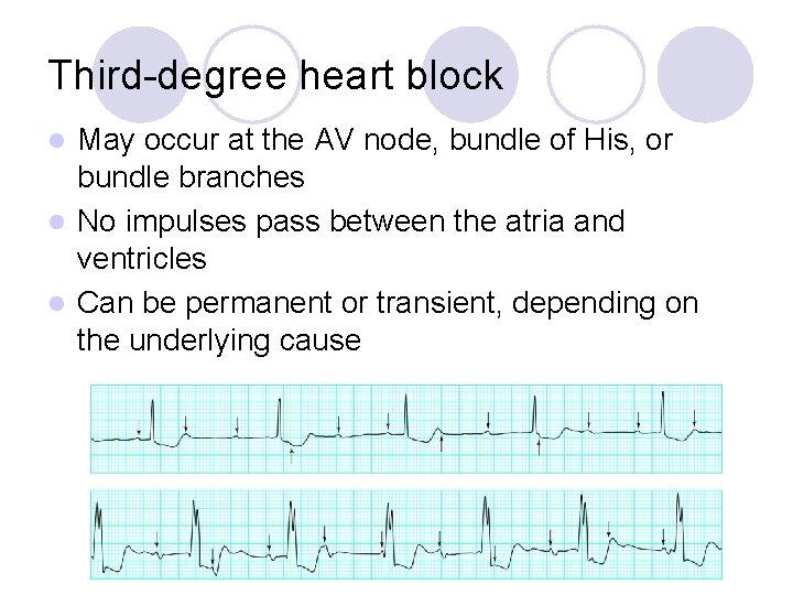 Third-degree heart block May occur at the AV node, bundle of His, or bundle