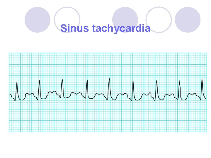 Sinus tachycardia 