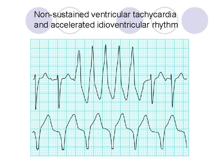 Non-sustained ventricular tachycardia and accelerated idioventricular rhythm 