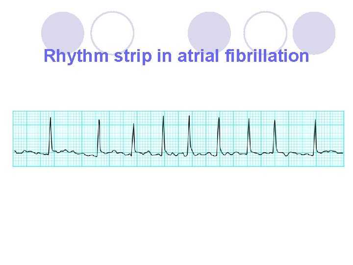 Rhythm strip in atrial fibrillation 