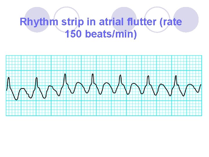 Rhythm strip in atrial flutter (rate 150 beats/min) 
