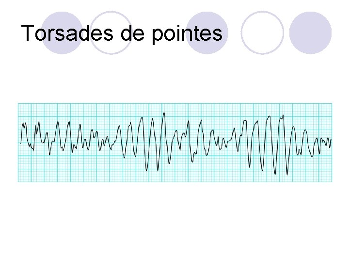 Torsades de pointes 