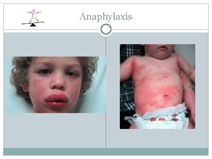 Anaphylaxis 