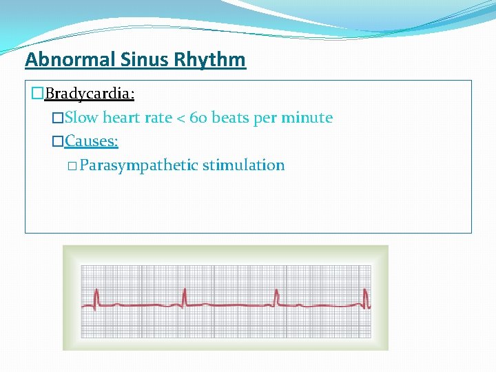 Abnormal Sinus Rhythm �Bradycardia: �Slow heart rate < 60 beats per minute �Causes: �