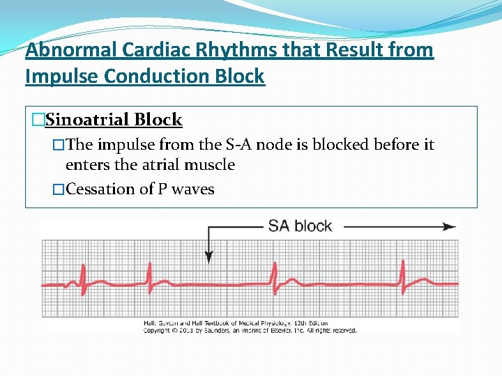 Abnormal Cardiac Rhythms that Result from Impulse Conduction Block �Sinoatrial Block �The impulse from