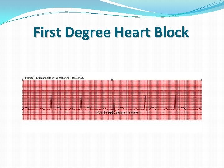 First Degree Heart Block 