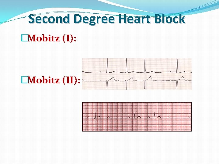 Second Degree Heart Block �Mobitz (I): �Mobitz (II): 