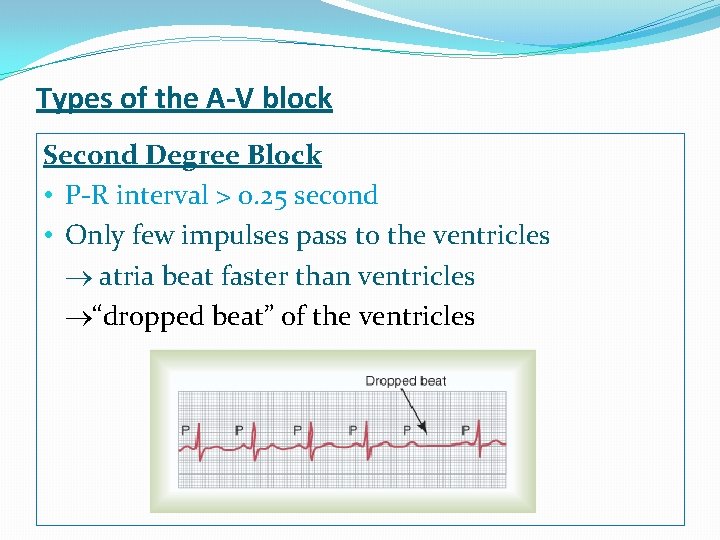 Types of the A-V block Second Degree Block • P-R interval > 0. 25