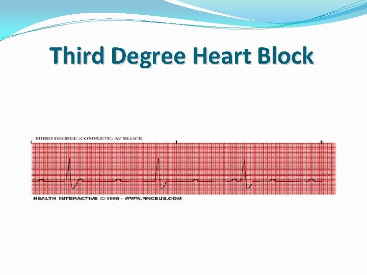 Third Degree Heart Block 