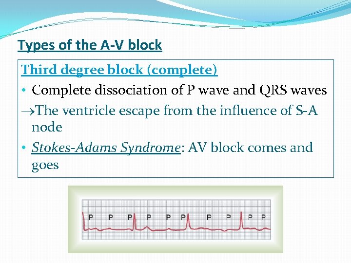 Types of the A-V block Third degree block (complete) • Complete dissociation of P