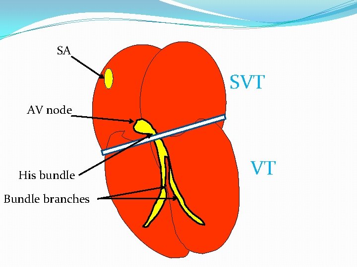 SA SVT AV node His bundle Bundle branches VT 