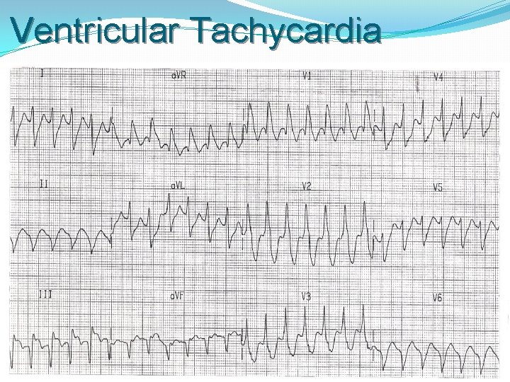 Ventricular Tachycardia 