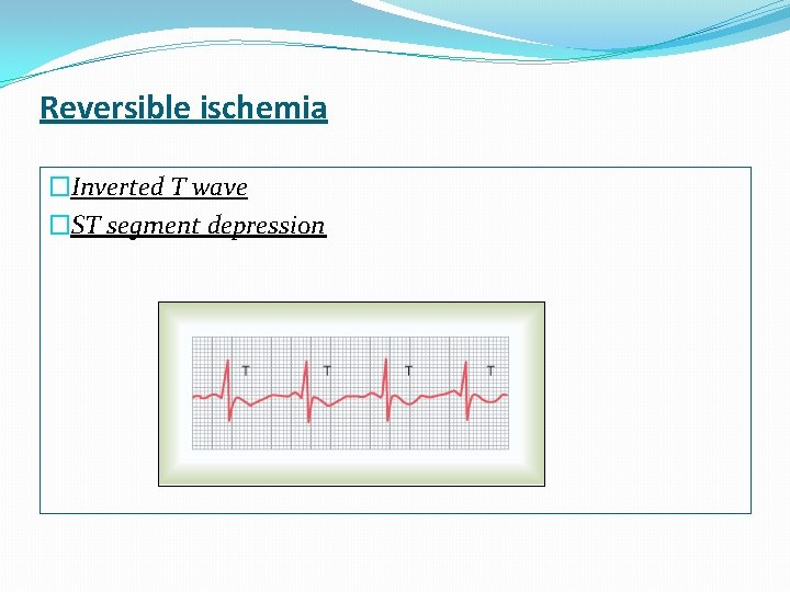 Reversible ischemia �Inverted T wave �ST segment depression 