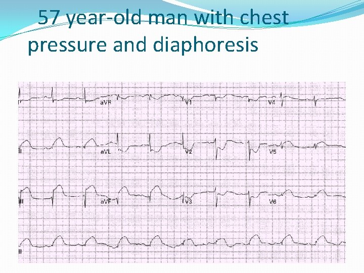 57 year-old man with chest pressure and diaphoresis 
