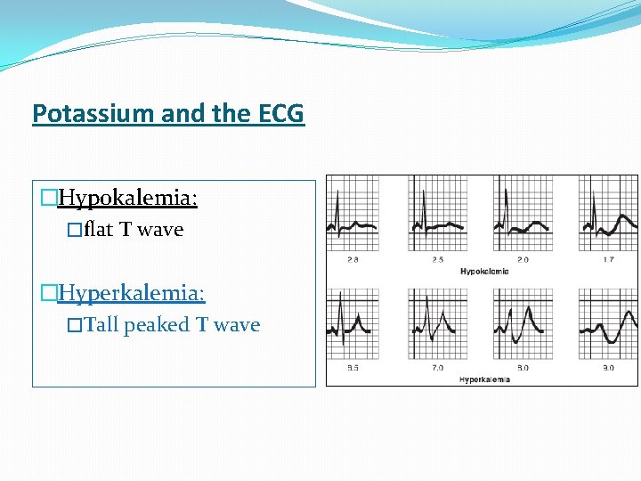 Potassium and the ECG �Hypokalemia: �flat T wave �Hyperkalemia: �Tall peaked T wave 