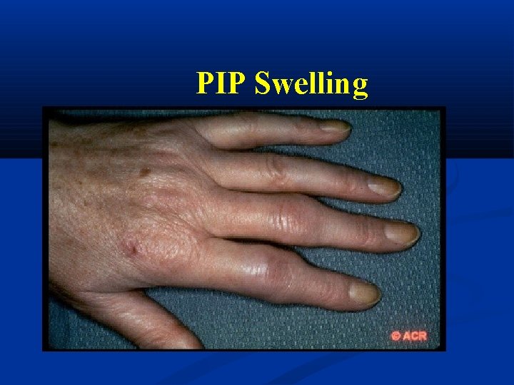 PIP Swelling 