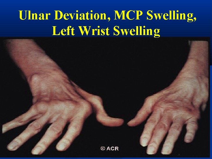 Ulnar Deviation, MCP Swelling, Left Wrist Swelling 