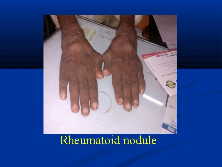 Rheumatoid nodule 