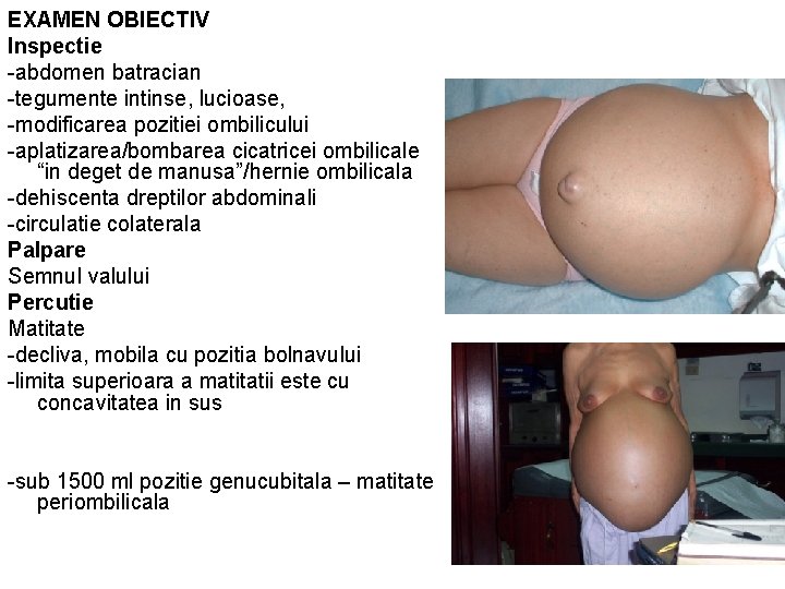 EXAMEN OBIECTIV Inspectie -abdomen batracian -tegumente intinse, lucioase, -modificarea pozitiei ombilicului -aplatizarea/bombarea cicatricei ombilicale