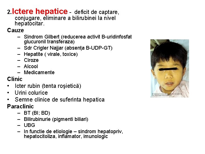 2. Ictere hepatice - deficit de captare, conjugare, eliminare a bilirubinei la nivel hepatocitar.